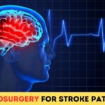 Neurosurgery for Stroke Patients