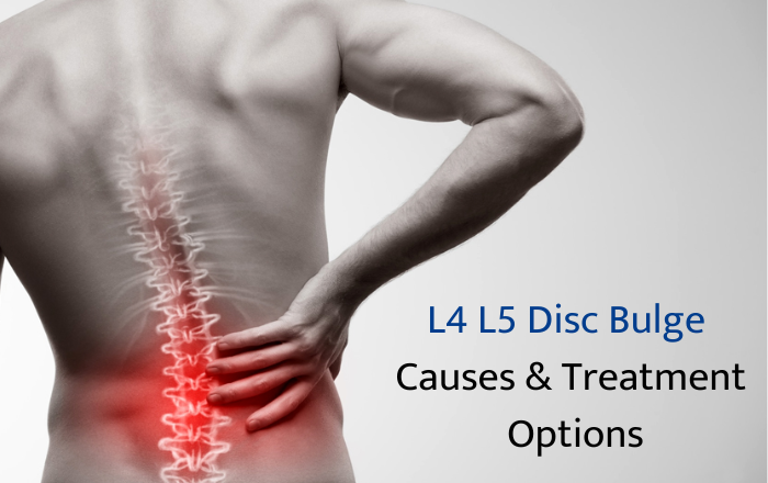 L4 L5 Disc Bulge - Causes & Best Treatment Options