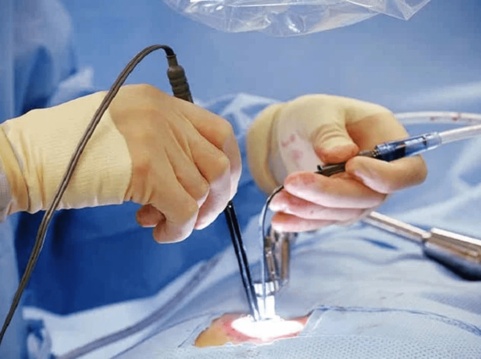 Endoscopic Spine Surgery