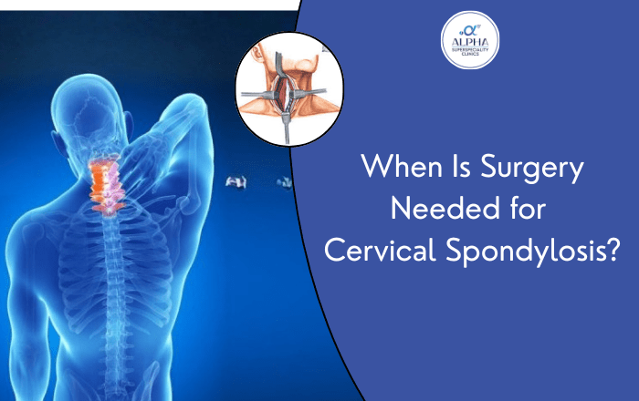 When Is Surgery Needed for Cervical Spondylosis?
